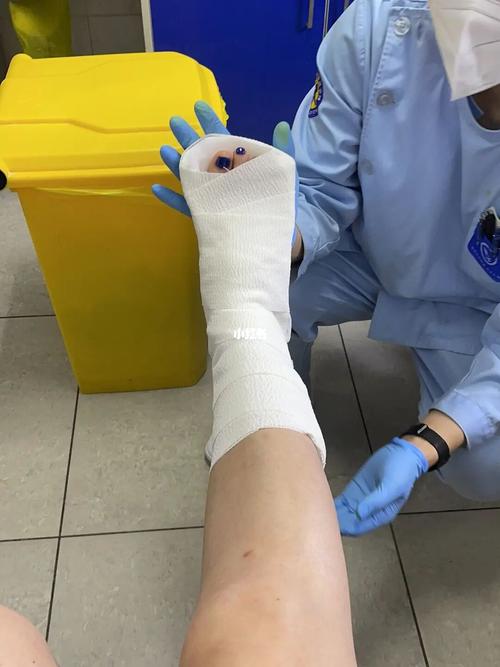跖骨5骨折,人生第一次打石膏_医疗健康_医疗健康其他