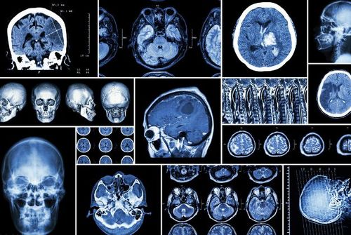 身体一旦出现1软2硬多半脑梗上身早查脑ct