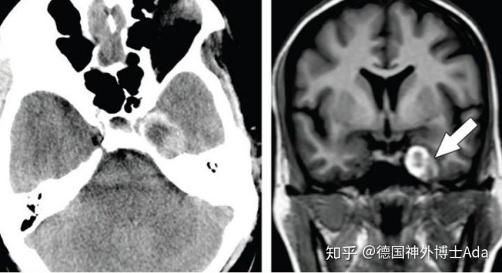世界海绵窦手术大师解析不同海绵窦肿瘤的手术决策