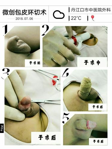 丹江口市中医院外科:微创包皮环切吻合术--安全,快捷,美观的包皮手术