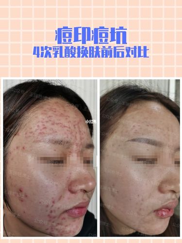 皮肤科案例·乳酸治疗痘印效果对比_痘印_痘痘_皮肤科_痘印痘坑_痤疮
