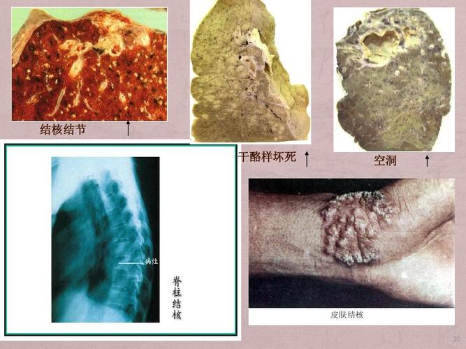 结核结节 干酪样坏死 空洞