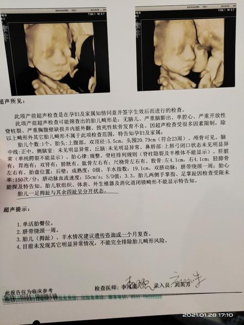 24周四维彩超显示胎儿足拇指与其余四指成