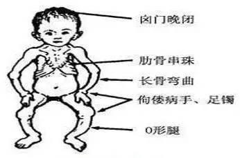 维护骨健康必不可少的营养素,维生素d缺乏和佝偻病和软骨病有关,与