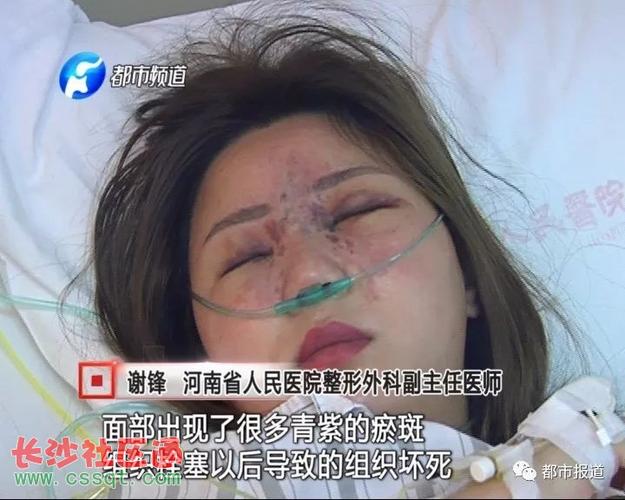 打支玻尿酸:河南某"平面模特脸"竟长满紫斑!