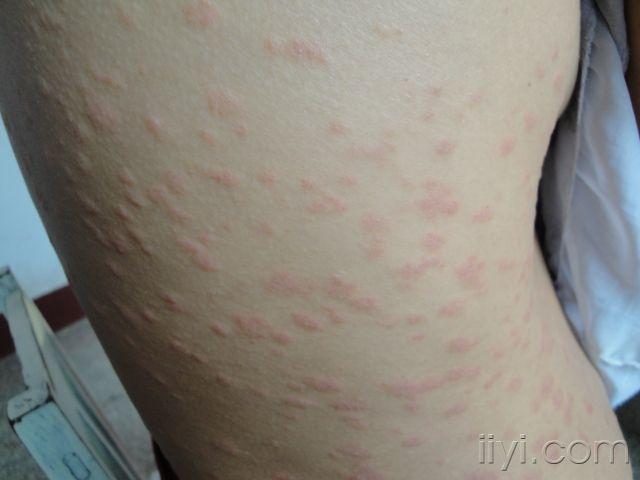 展开全部  玫瑰糠疹