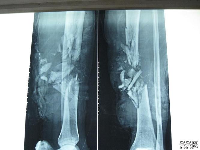 请教胫骨开放性粉碎性骨折的治疗