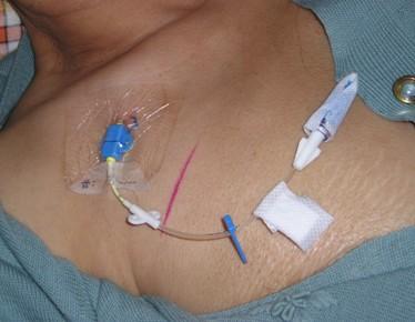 颈内静脉穿刺置管术