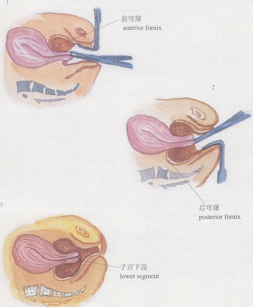 图434穹窿纱布块填塞术
