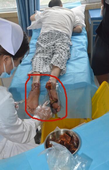 不截肢治疗糖尿病足的方法!