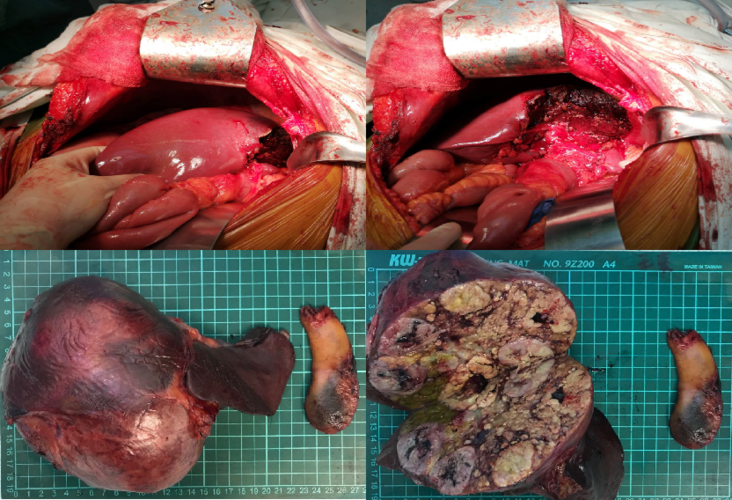 【肝胆相鉴】肝癌治疗病例——新华医院,龚伟