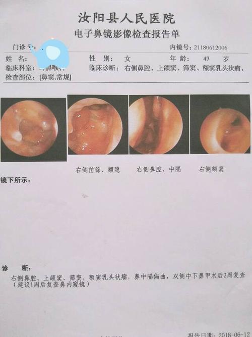 术后2周复查鼻内窥镜报告