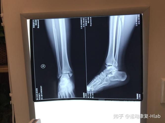 骨折术前x光片