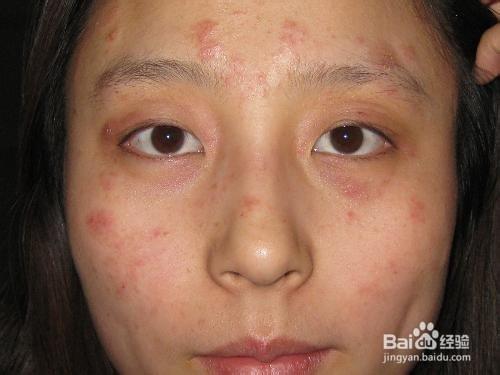 湿疹的治疗方法有那些?