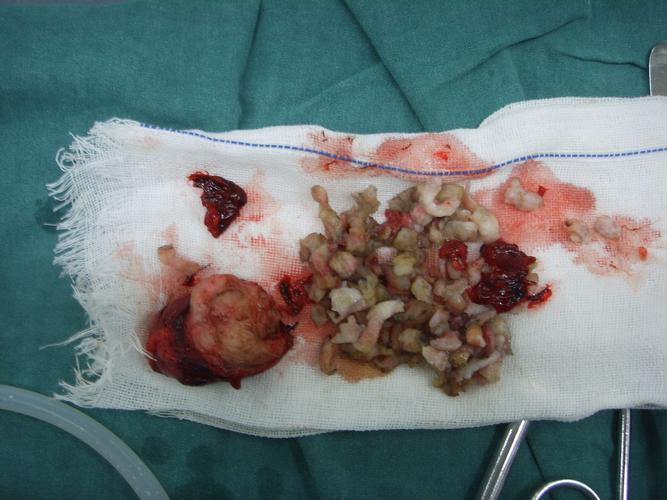 宫腔镜下切除巨大粘膜下子宫肌瘤