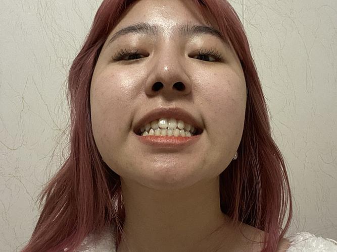 门牙歪斜建议矫正