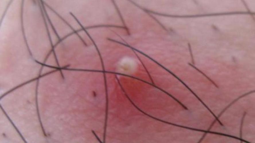 毛囊炎是金黄色葡萄球菌侵入毛囊引起的化脓性损害,是生在毛囊部位的