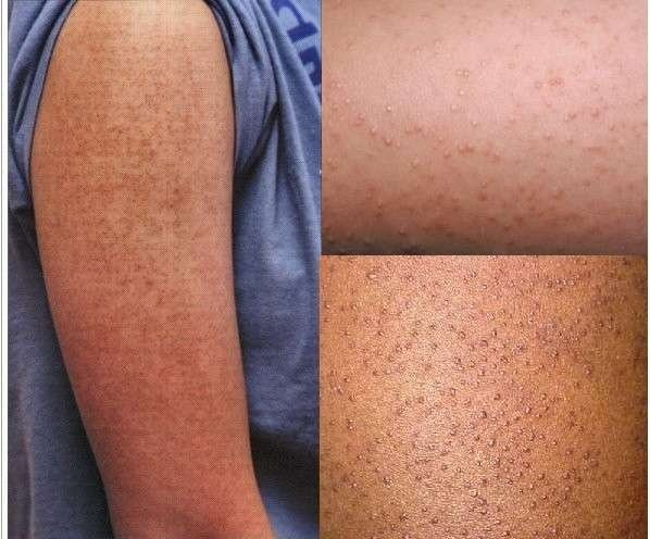 胳膊上的鸡皮肤怎么去掉 最有效的方法决定胜败