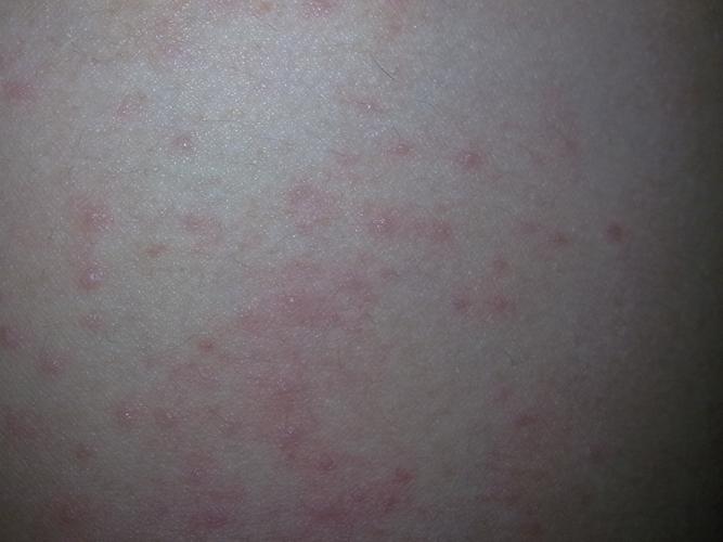 不要吃辛辣的食物,忌烟酒.吃些抗过敏药"开瑞坦"或"苯海拉明".