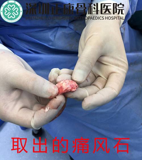 深圳小伙痛风取出痛风石 走路不再痛