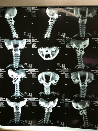 术后颈椎三维重建
