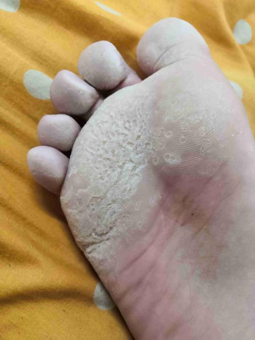 这种是属于脚气吗 臭的很98?