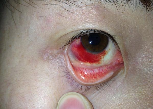 【右眼有血块】而且瞳孔旁感觉有脓块~~~不是红眼病吧