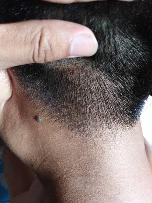 为什么我后脑勺头皮上,有好多红斑点,痘痘,这里有图片