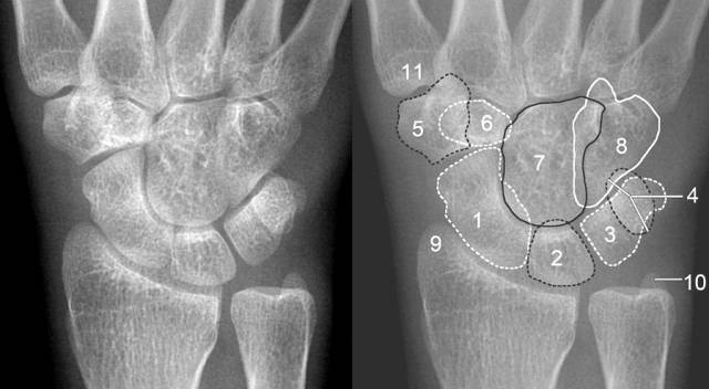 腕关节脱位及x线阅片技巧
