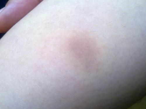 急求判断!是否是紫癜