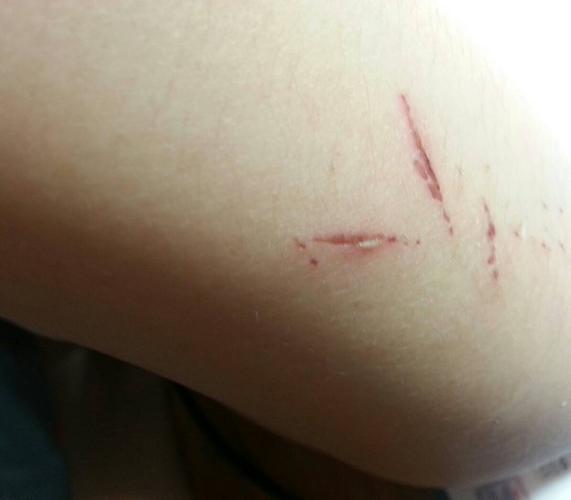 摔跤了手臂上受了伤,当时用水和含酒精成分的湿巾纸清洁了伤口,伤口不