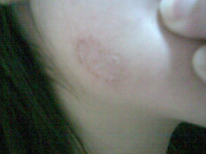 我的脸上 前两天有点痒痒 我就不自觉的给挠破了,直到同事说你脸怎么