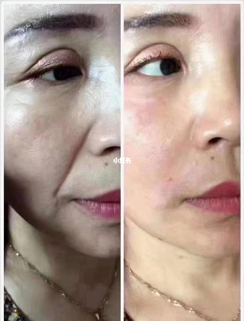 面具_法令纹_干纹_构衰老