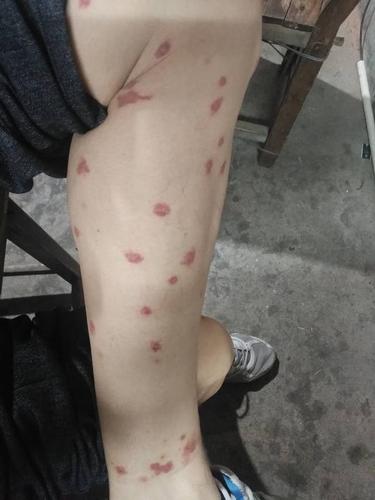 皮肤红疹奇痒,一开始在脚碗有几个红点,己为蚊子咬的