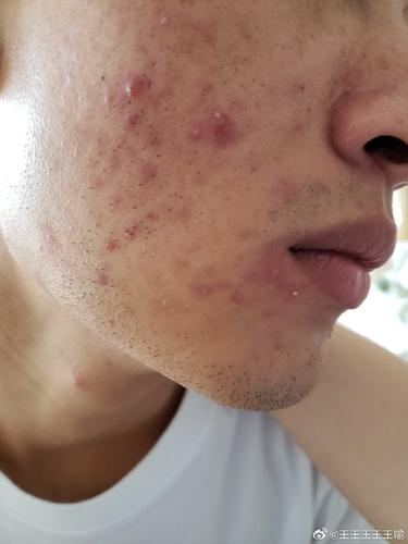 面部痤疮图片