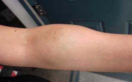 血管瘤的6种症状表现是什么样的?