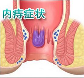 1.痔核脱出这是晚期症状.