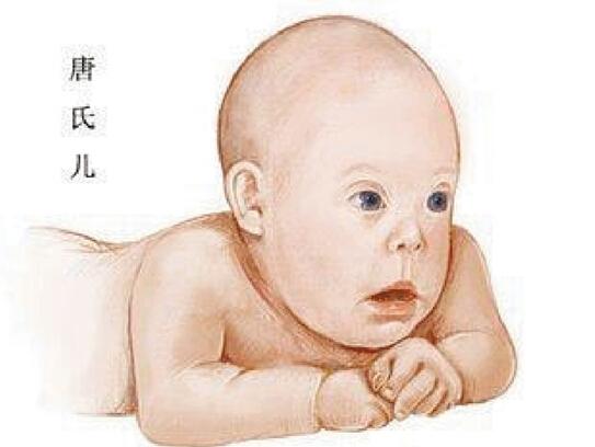 养生人群 幼儿保健 正文   唐氏综合征即21-三体综合征,又称先天愚型