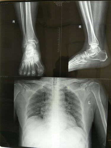 其它 踝关节骨性关节病如何治疗 写美篇 2017年8月ct平扫 2017年12月