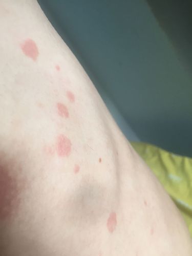 身上长红色的圆形的斑点是什么病