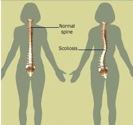 脊柱侧弯,最应该知道的那些事!