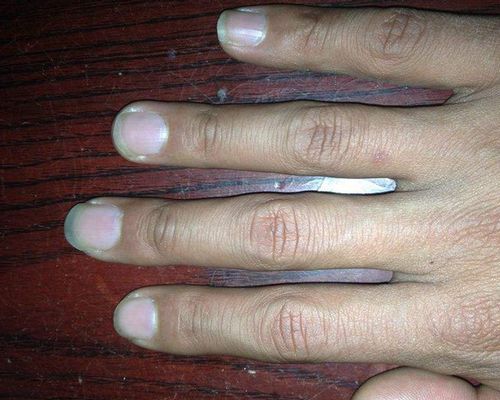 疾病预防 杵状指形成原因 杵状指鉴别方式