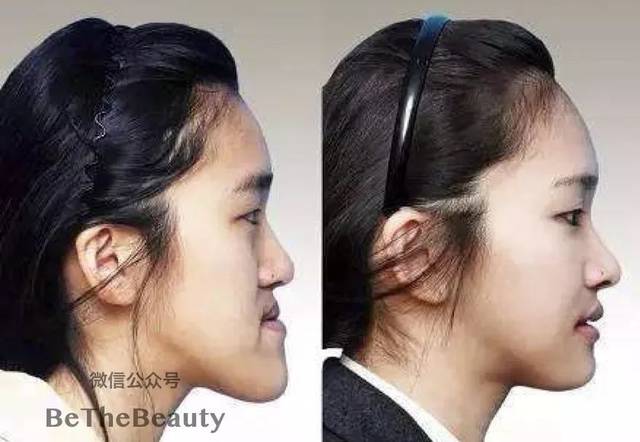 左图:一个反颌的妹子;右图:正颌手术后 一般来说,由于反颌(地包天)