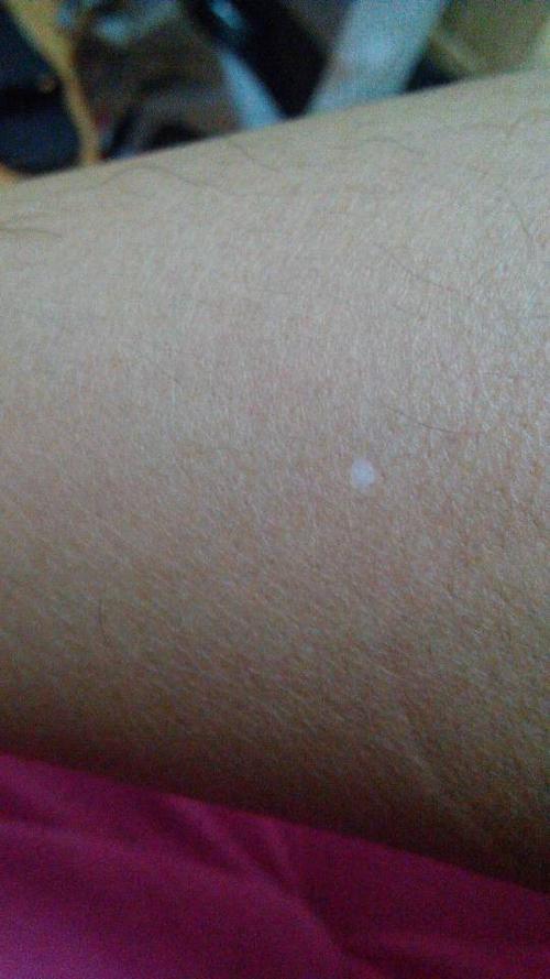 问:左手臂,右大腿,左右1腿都有1个白斑,是什么病?
