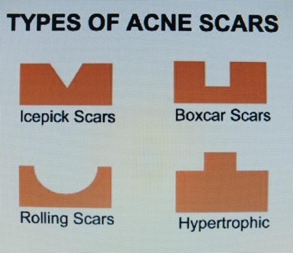 acne scar types