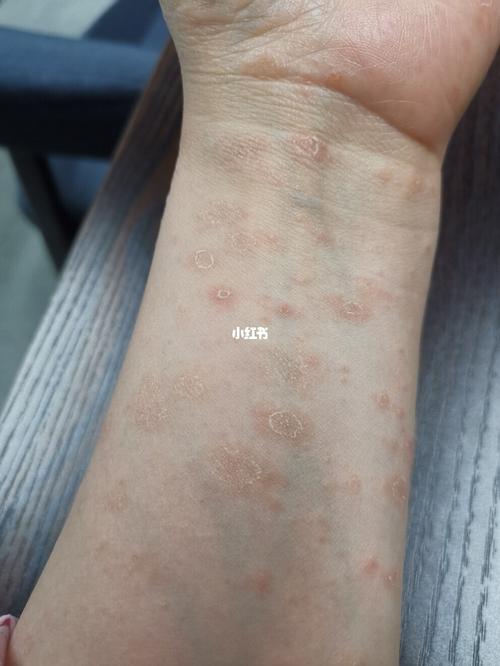 玫瑰糠疹_免疫力_医疗健康_医疗健康其他