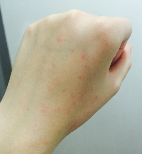 手背上有好多小红点 不是太明显 凑近了能看见,咋回事