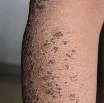 得了鱼鳞病的危害大吗