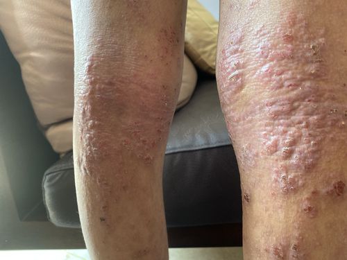 十年湿疹,特应性皮炎.