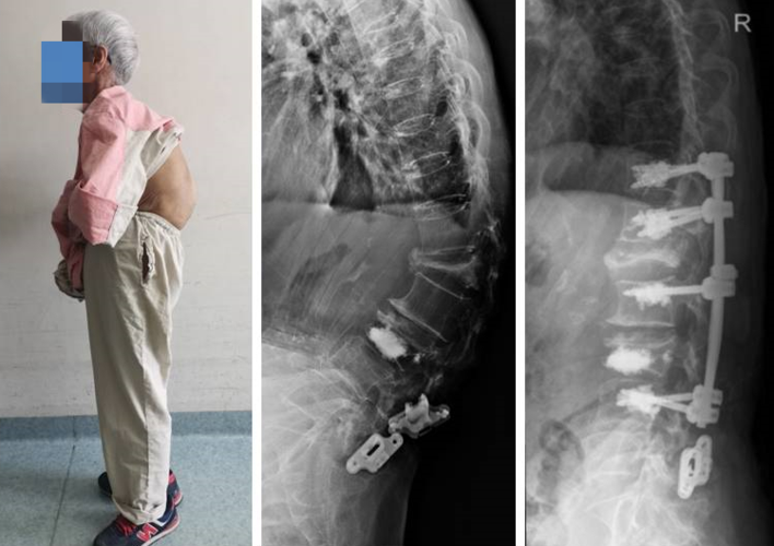 近半年来,张阿姨的身体逐渐出现脊柱后凸畸形,并且进行性加重,无法